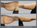Case 45.1- Brachioplasty