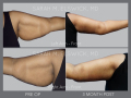 Case 45.2- Brachioplasty