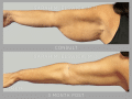Case-99A-Brachioplasty