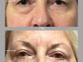 Case 80- Blepharoplasty