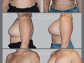 Case 6- Breast Augmentation