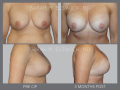 Case 17- Breast Augmentation Revision