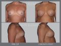 Case 3- Breast Augmentation