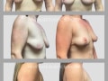 Case 166 - Breast Lift