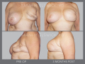 Case 38- Breast Reconstruction Revision