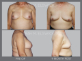 Case 31- Breast Implant Removal