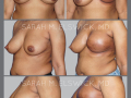 Case 35- Breast Reconstruction: Direct to Implant