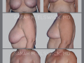 Case 23- Breast Reduction