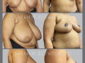 Case 30- Breast Reduction