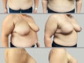 Case 175-Breast-Reconstruction