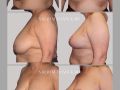 Case 27- Breast Reduction