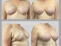 Case 37- Breast Reconstruction Revision