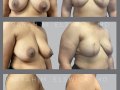Case 74- Breast Reconstruction : Direct to Implant with Mastopexy