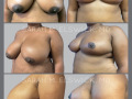 Case 22- Breast Reduction 