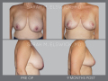 Case 26- Breast Reduction