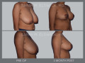 Case 25- Breast Reduction 