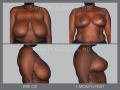 Case 29- Breast Reduction