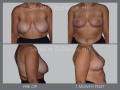 Case 28- Breast Reduction