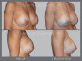 Case 39- Breast Fat Grafting