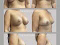 Case 73- Breast Implant Removal, Mastopexy, and Fat Transfer