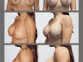 Case 41- Breast Augmentation Revision