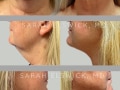 Case-0078-Liposuction-Chin-Neck