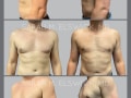 Case-96-Gynecomastia