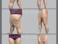 Case 0224-Liposuction: Thighs