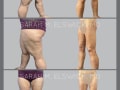 Case 0226-Staged Thigh Liposuction and Thigh Lift