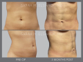 Case 60- Liposuction: Abdomen