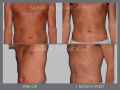 Case 51- Liposuction: Abdomen