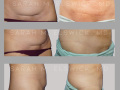 Case 65- C-Section Scar Revision