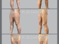 Case 0225-Thigh-Lift