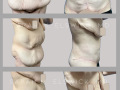 Case 14- Abdominoplasty: Fleur-de-lis