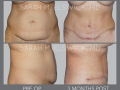 Case 13- Abdominoplasty