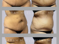 Case 104- Panniculectomy