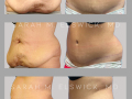 Case 110- Abdominoplasty