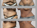 Case 111- Abdominoplasty and Oblique Flankplasty