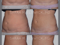 Case 57- Abdominoplasty Revision