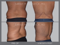 Case 58.1- Body Lift